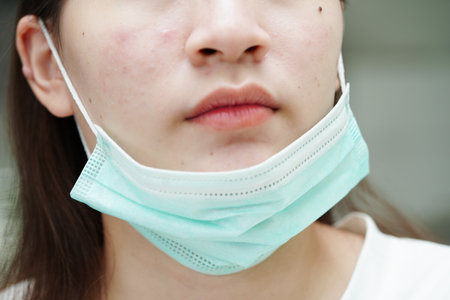 Acne pimple and scar on skin face, disorders of sebaceous glands, teenage girl skincare beauty problem.の写真素材