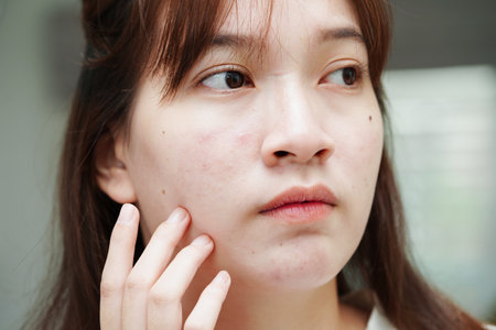 Acne pimple and scar on skin face, disorders of sebaceous glands, teenage girl skincare beauty problem.の写真素材