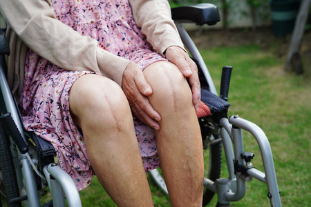 Asian elderly woman patient with scar knee replacement surgery in hospital.の写真素材