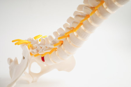 Spinal nerve and bone, Lumbar spine displaced herniated disc fragment, Model for treatment medical...