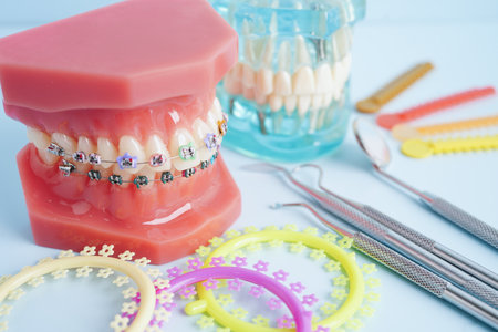 Orthodontic ligatures rings and ties, elastic rubber bands on orthodontic braces, model for dentist...