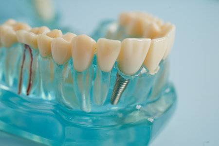 Dental implant, artificial tooth roots into jaw, root canal of dental treatment, gum disease, teeth model for dentist studying about dentistry.の写真素材