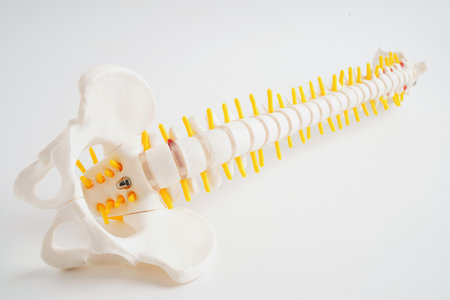 Spinal nerve and bone, Lumbar spine displaced herniated disc fragment, Model for treatment medical...