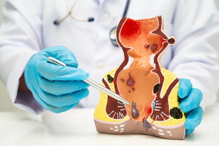 Asian doctor with rectum and hemorrhoid human anatomy model at hospital, inflamed vascular structure.の写真素材