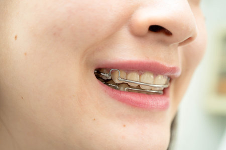 Asian woman wearing Hawley retainer removable orthodontic appliance maintain position of teeth.