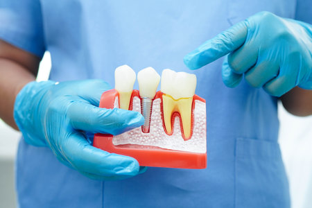 Doctor hold dental implant, artificial tooth roots into jaw, root canal of dental treatment, gum...