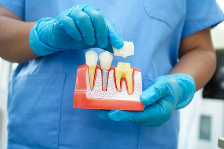 Doctor hold dental implant, artificial tooth roots into jaw, root canal of dental treatment, gum...