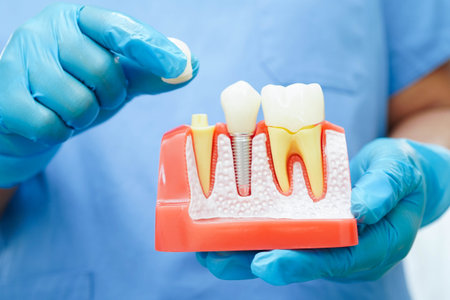 Doctor hold dental implant, artificial tooth roots into jaw, root canal of dental treatment, gum disease, teeth model for dentist studying about dentistry.の写真素材