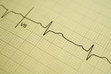 Electrocardiogram (ECG), heart wave, heart attack, cardiogram report.