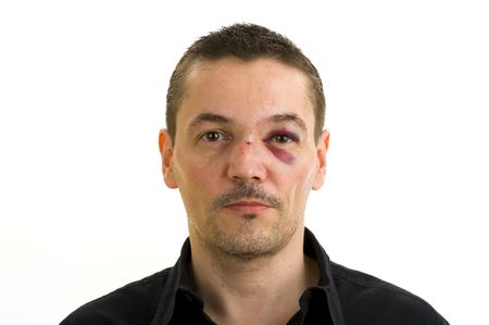 man with broken, crooked nose and black eye isolated on whiteの写真素材