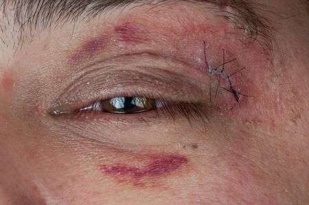 close-up of a stitched wound next to a man's eyeの写真素材