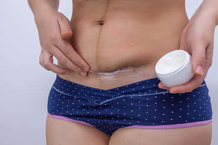A woman after giving birth smears ointment on the scar from a caesarean sectionの写真素材