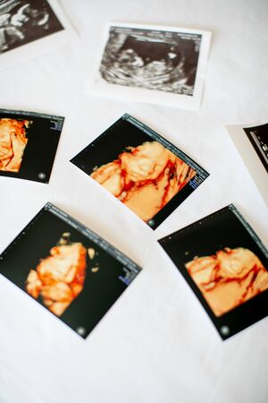 photos of scan baby on a bed