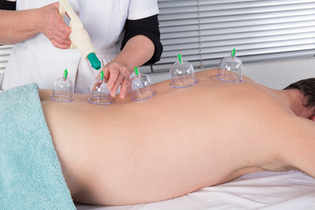 Cupping or Bekam Hijamah is traditional treatment