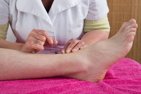 acupuncture for manの写真素材