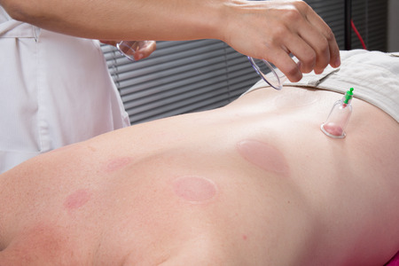 Detail of an acupuncture therapist removing a plastic  globe in a  cupping procedure