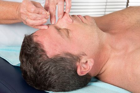 Man in an acupuncture therapy at the health spaの写真素材