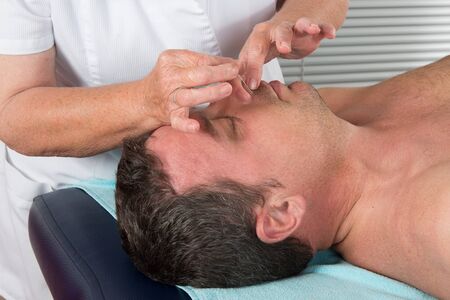 Man in an acupuncture therapy at the health spaの写真素材
