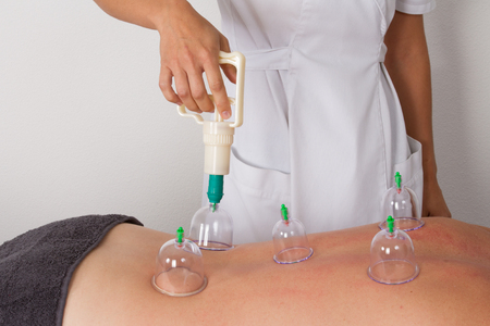Detail of an acupuncture therapist removing a glass globe in a fire cupping procedureの写真素材