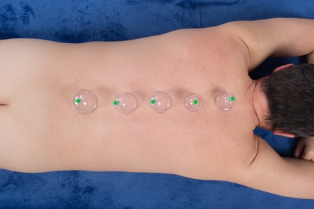 Man with acupuncture cupping treatment on back