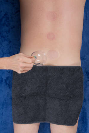Cupping is an ancient form of Chinese alternative medicine, claimed to cure many ailments. Medical...