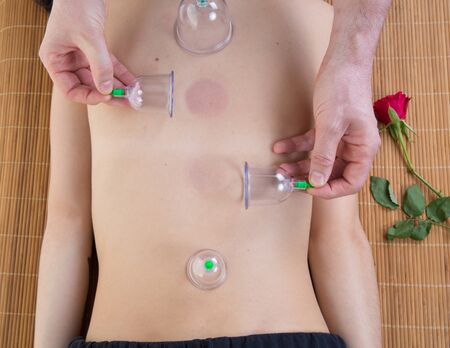Cupping chinese massage at a chinese  doctor roomの写真素材