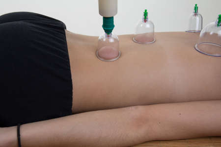 Cupping therapy, spa, woman doctor removes cups from the patient's back
