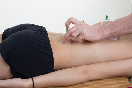 Cupping therapy, spa, woman doctor removes cups from the patient's backの写真素材