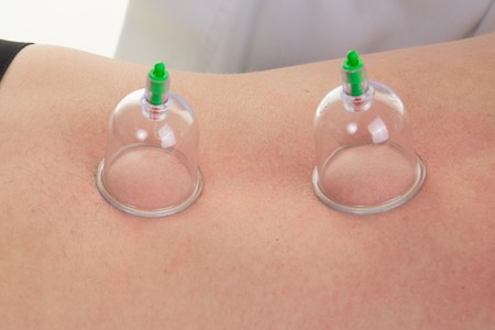 Acupuncture therapist placing cup on the back of male patient
