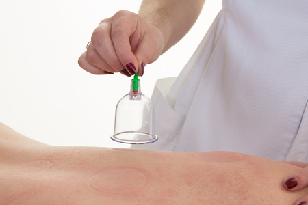 Male laying on chest with cupping treatment on backの写真素材
