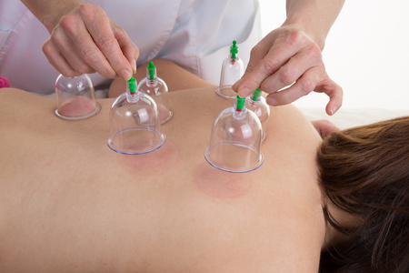 A Chinese medicine cupping of the back of young ladyの写真素材