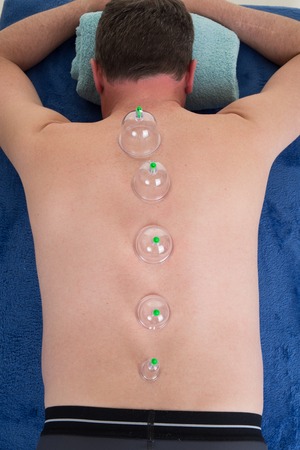 Medical cupping therapy on man bodyの写真素材