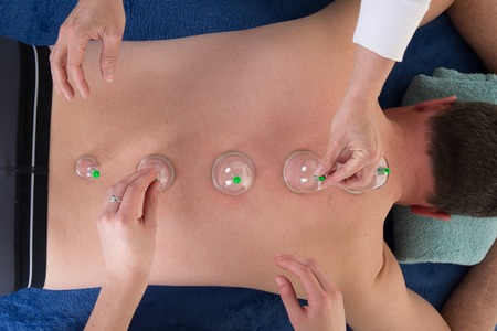Multiple vacuum cup of medical cupping therapy on human bodyの写真素材