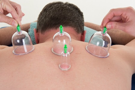 Multiple vacuum cup of medical cupping therapy on human bodyの写真素材