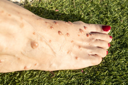 Close-up medical photograph showing the foot of a female patient with neurofibromatosisの写真素材