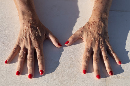 Close-up image showing the hands of a female patient affected by neurofibromatosisの写真素材