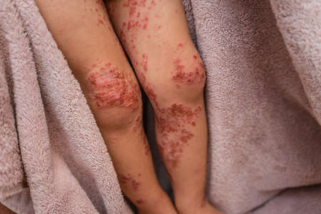 Close up enterovirus on baby bodyの写真素材