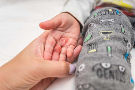 Close up enterovirus on baby bodyの写真素材