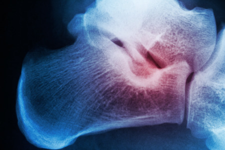 Color X-ray photo of foot with broken cord. Pain spot indicated with red color.