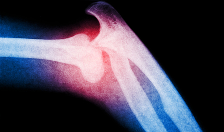 X ray bone scan. Skeleton with red color indicated pain spot.の写真素材