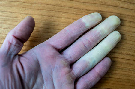 A frostbitten male hand with Raynaud's syndrome, Raynaud's phenomenon or Raynaud's disease.