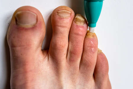 Using a pen against nail fungus. Nail fungal infection treatment.の写真素材