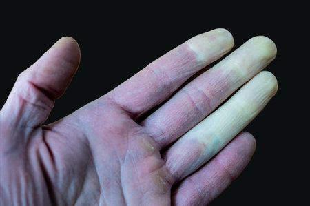 A frostbitten male hand with Raynaud's syndrome, Raynaud's phenomenon or Raynaud's disease isolated...