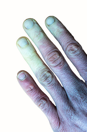 A frostbitten male hand with Raynaud's syndrome, Raynaud's phenomenon or Raynaud's disease isolated in a white background.の写真素材