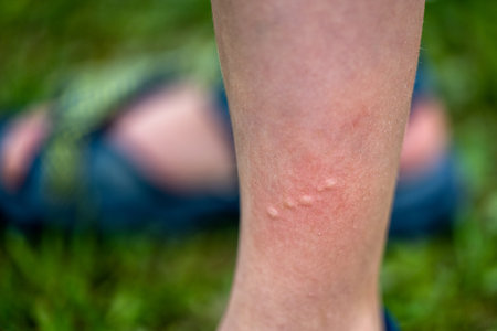 Close-up of a child's leg with stinging nettle blisters.の写真素材