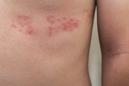 Detail of body skin with Herpes Zoster (Shingles)の写真素材