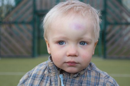 One year old boy with bump on a headの写真素材