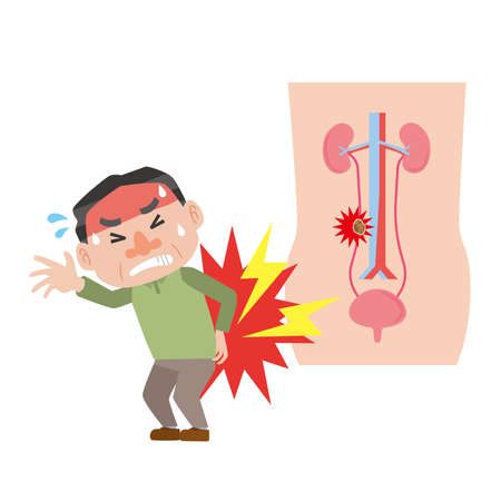 Men suffering from ureteral stones painのイラスト素材