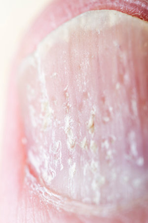 Extreme close up of psoriasis at the nail. Psoriasis is an autoimmune disease that affects the skin...
