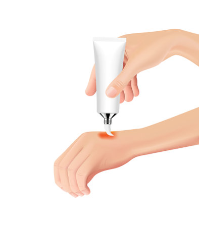 Skin burn injury treatment. First aid for burn wound vector illustration, hand with skin injury.のイラスト素材